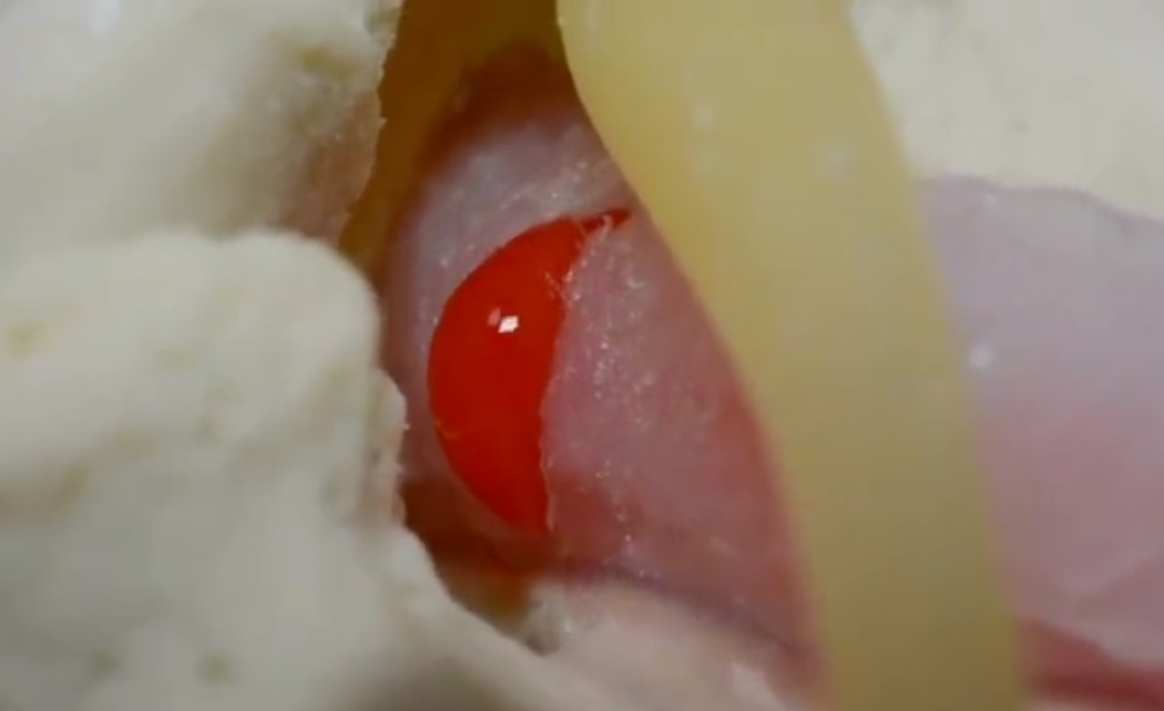 Lændehvirvler m. diskusprolaps