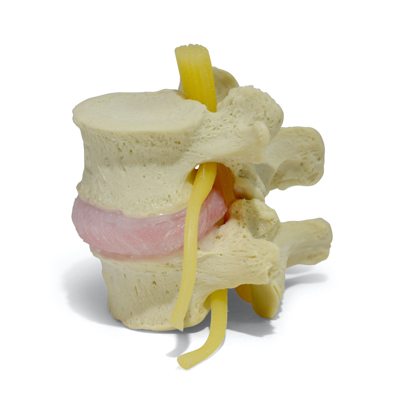 Lumbar vertebrae with herniated disc