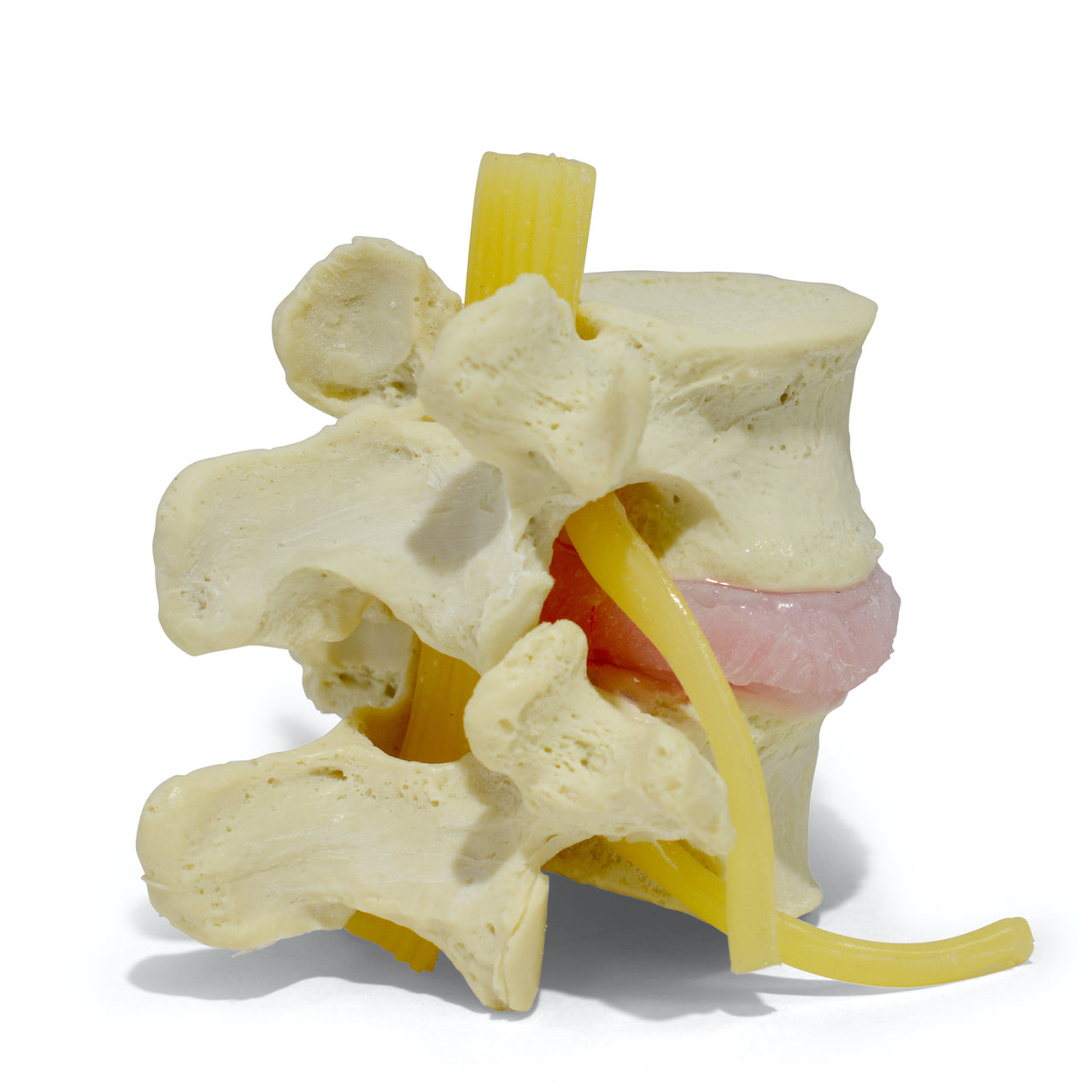Lumbar vertebrae with herniated disc