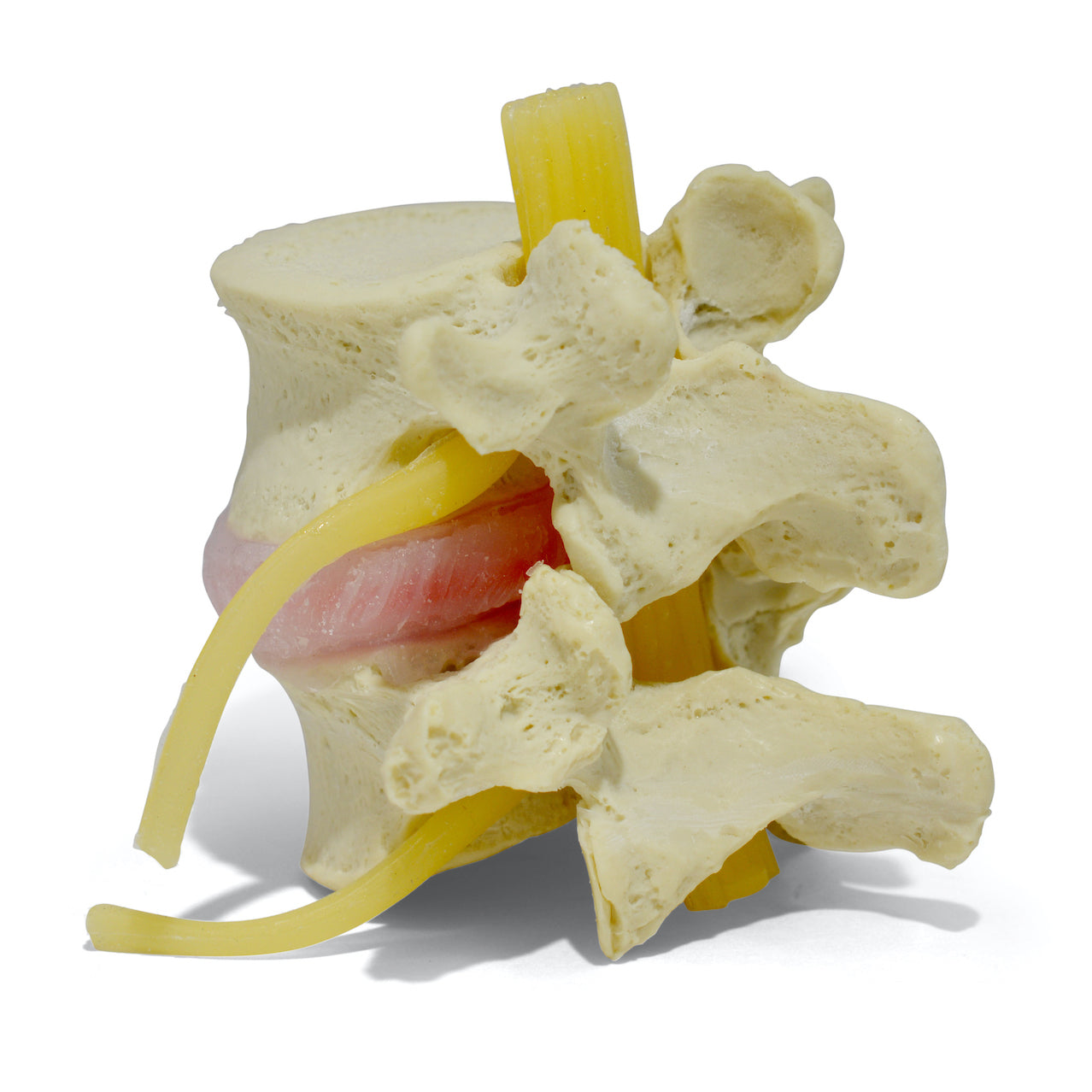 Lumbar vertebrae with herniated disc