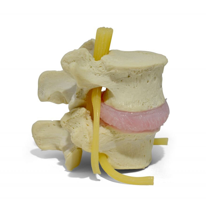 Lumbar vertebrae with herniated disc