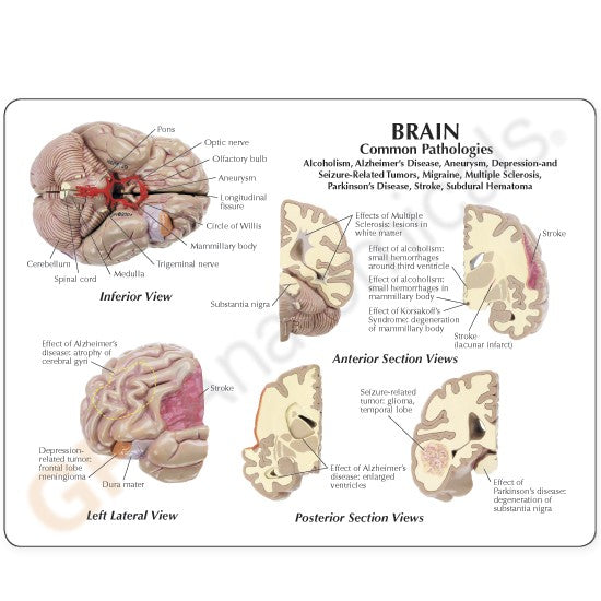 Brain with brain injuries