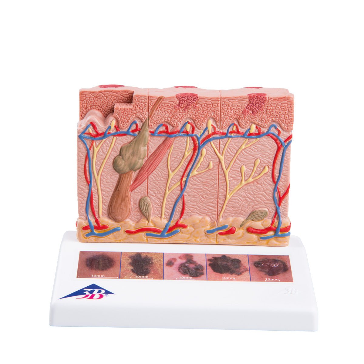 Cancer Birthmark Model of birthmark cancer in different stages In eAnatomi.dk
