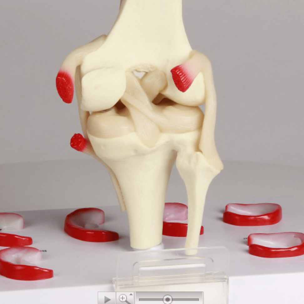 Meniscus Modeled Knee model with meniscal lesions and ligaments – eAnatomi