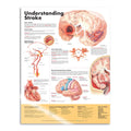 Lamineret plakat om apopleksi på engelsk - eAnatomi