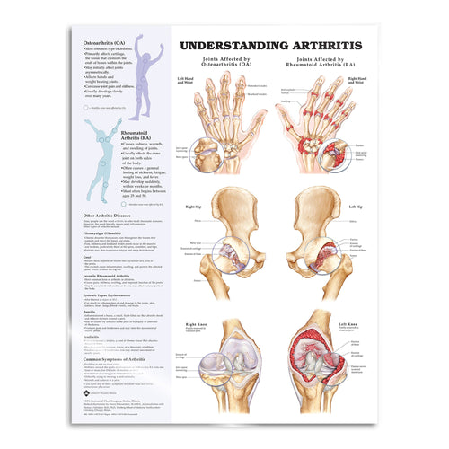 Lamineret plakat om artritis på engelsk - eAnatomi