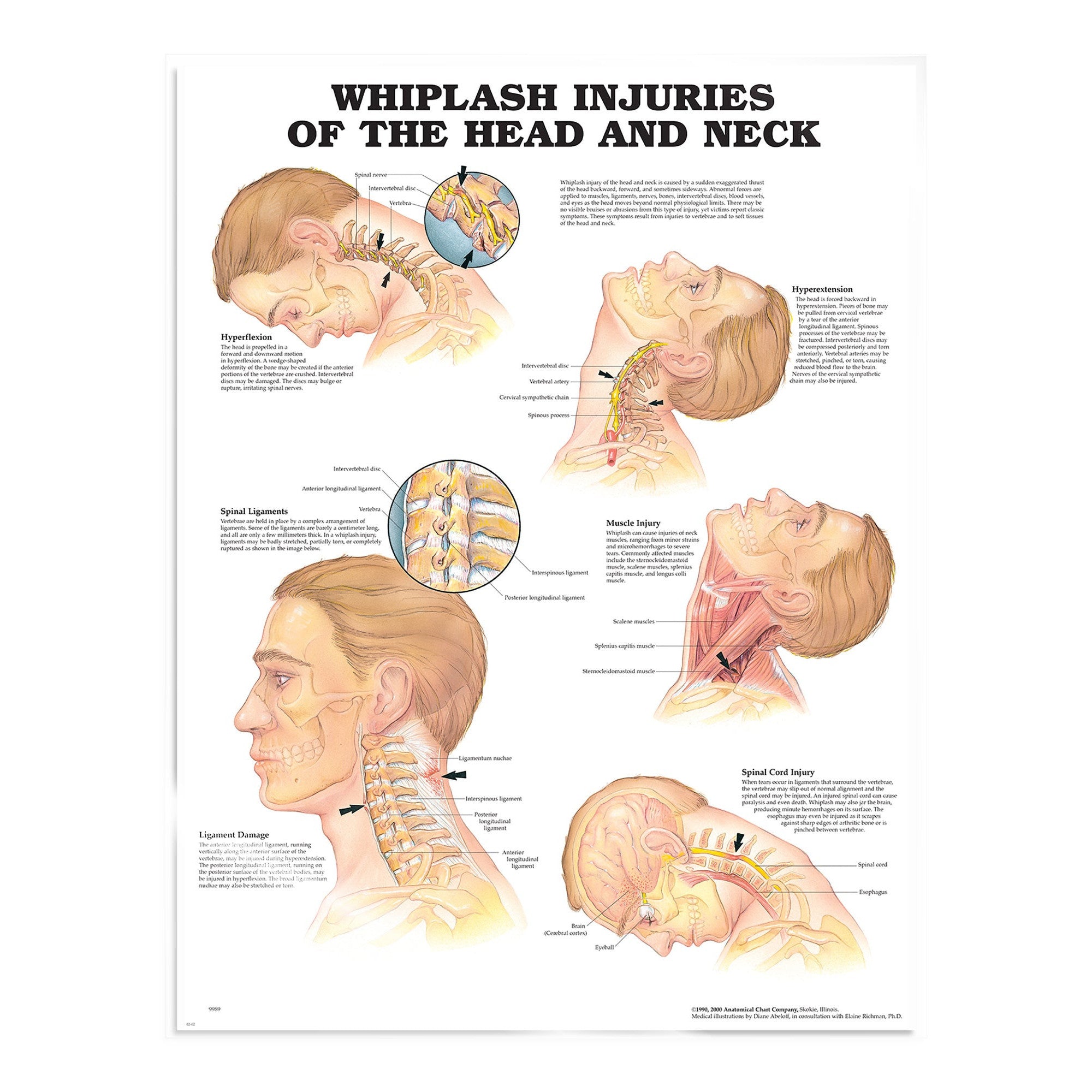 Laminated poster about whiplash injuries in English 