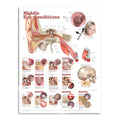 Lamineret plakat om sygdomme i mellemøret på engelsk - eAnatomi