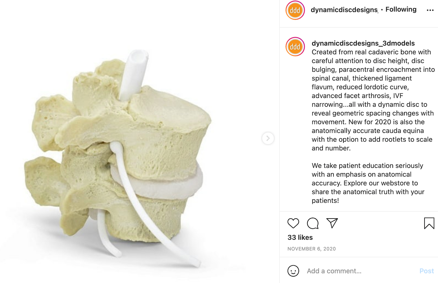 Lumbar vertebrae with spinal stenosis
