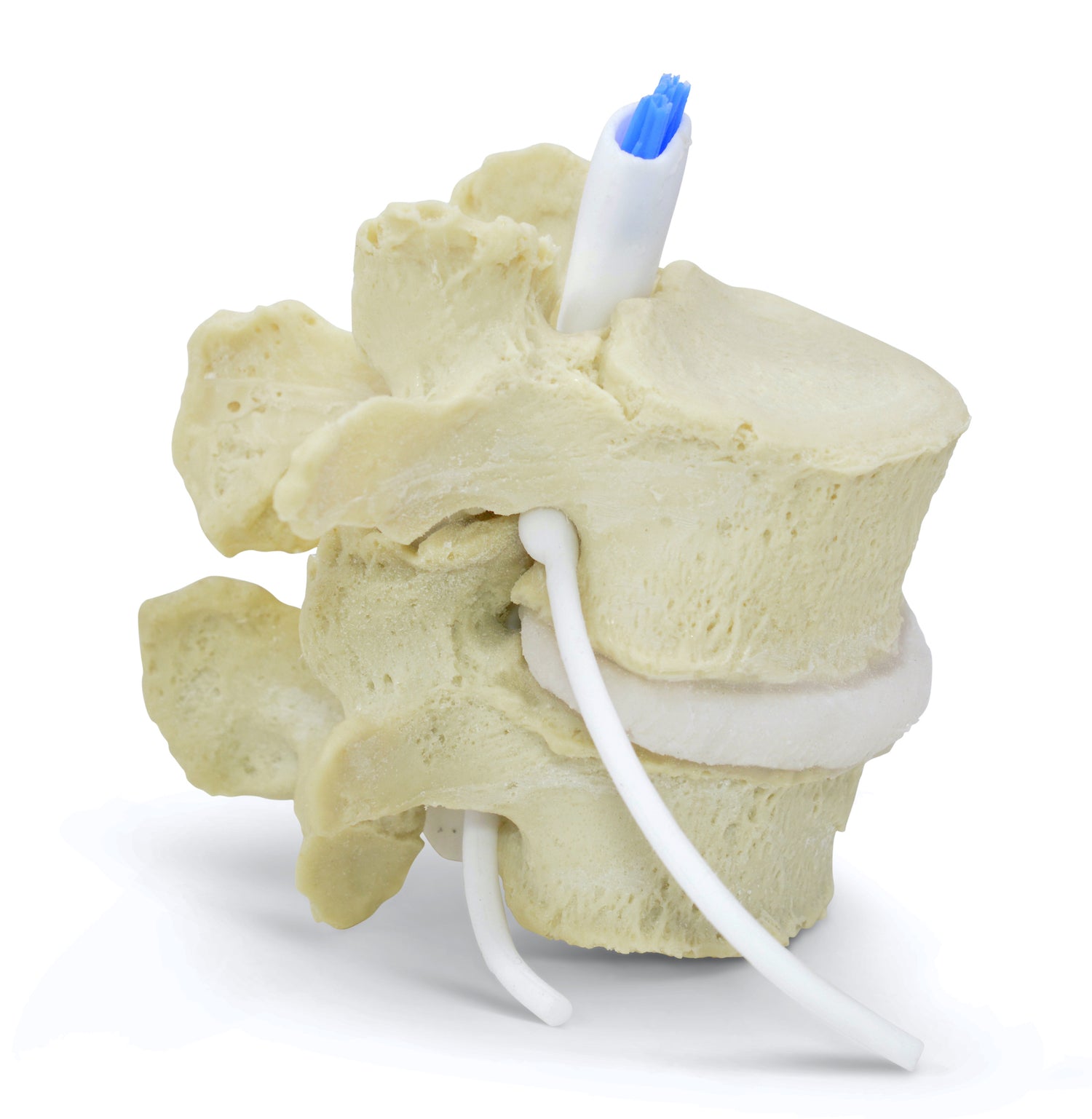 Lumbar vertebrae with spinal stenosis