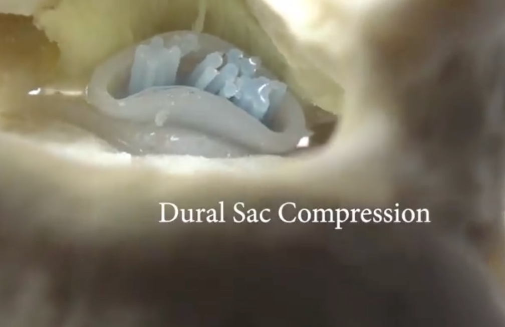 Lumbar vertebrae with spinal stenosis
