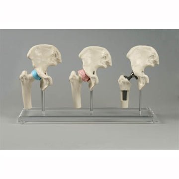 3 formindskede hofter, sund/atrose/protese - eAnatomi