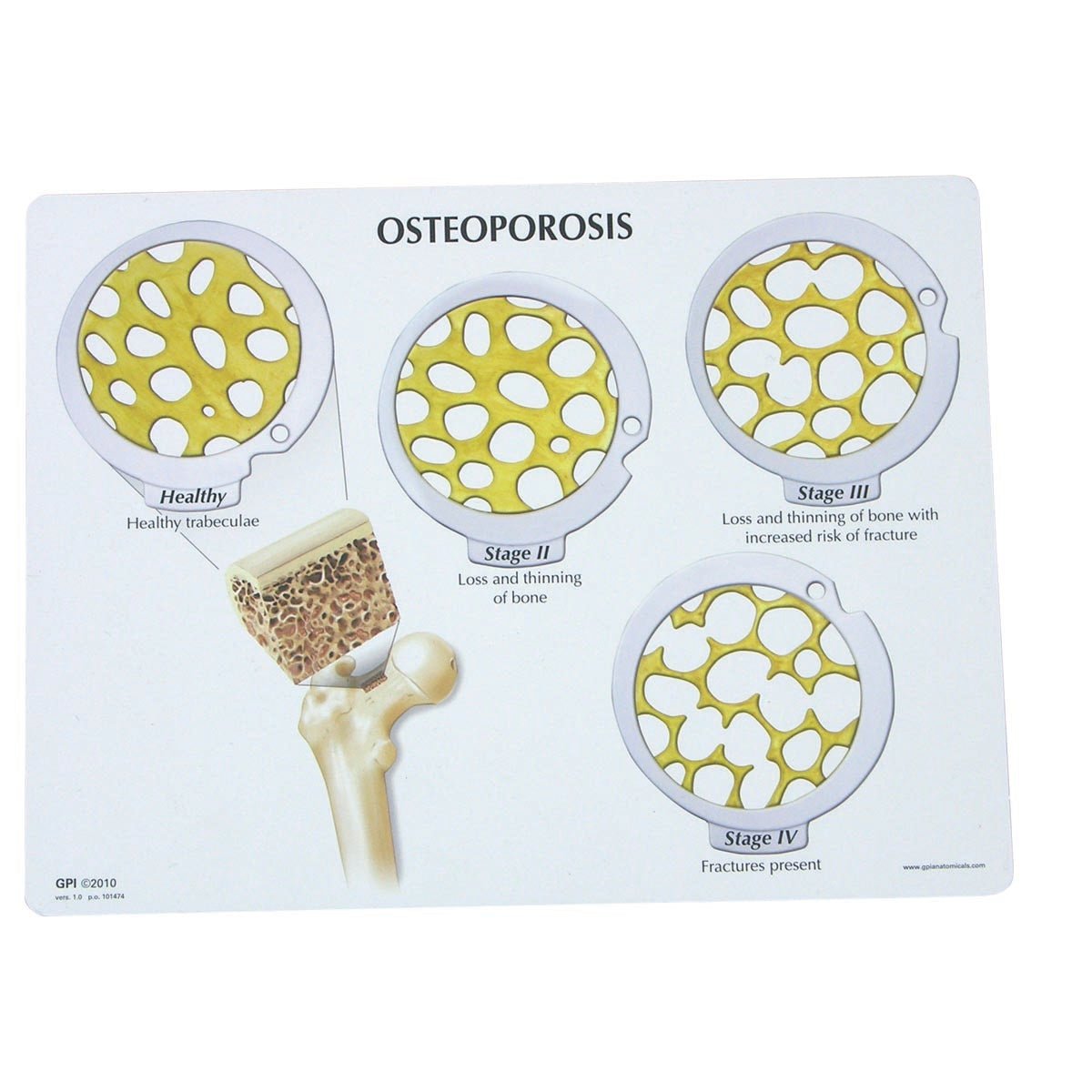 Model af knoglevæv og osteoporose i skiver - eAnatomi