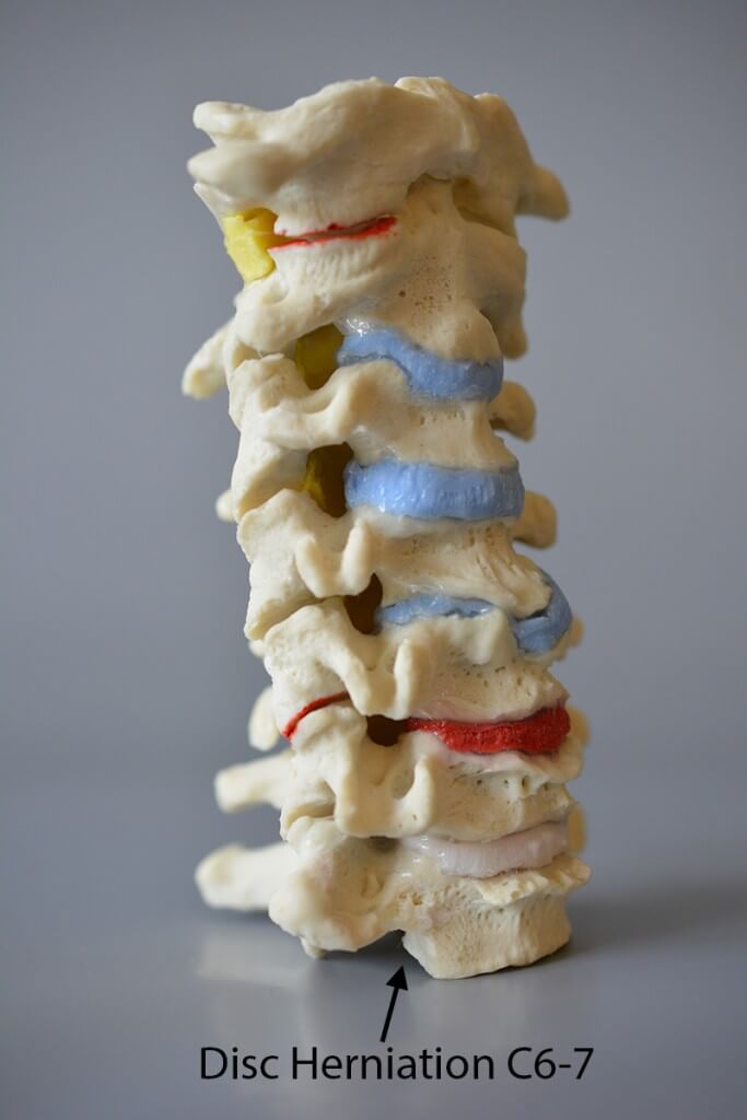 Cervical vertebrae m. degenerative changes