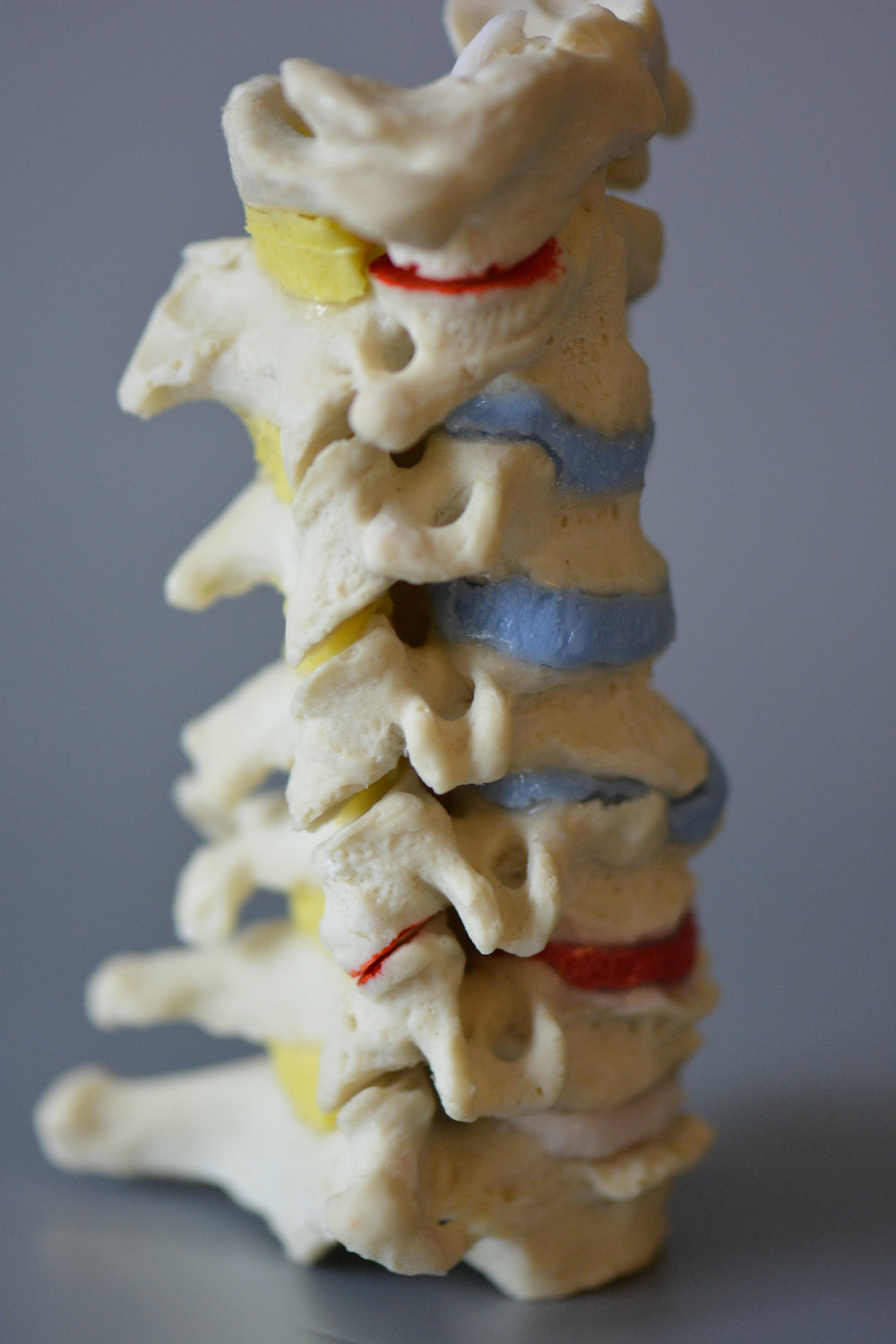Cervical vertebrae m. degenerative changes