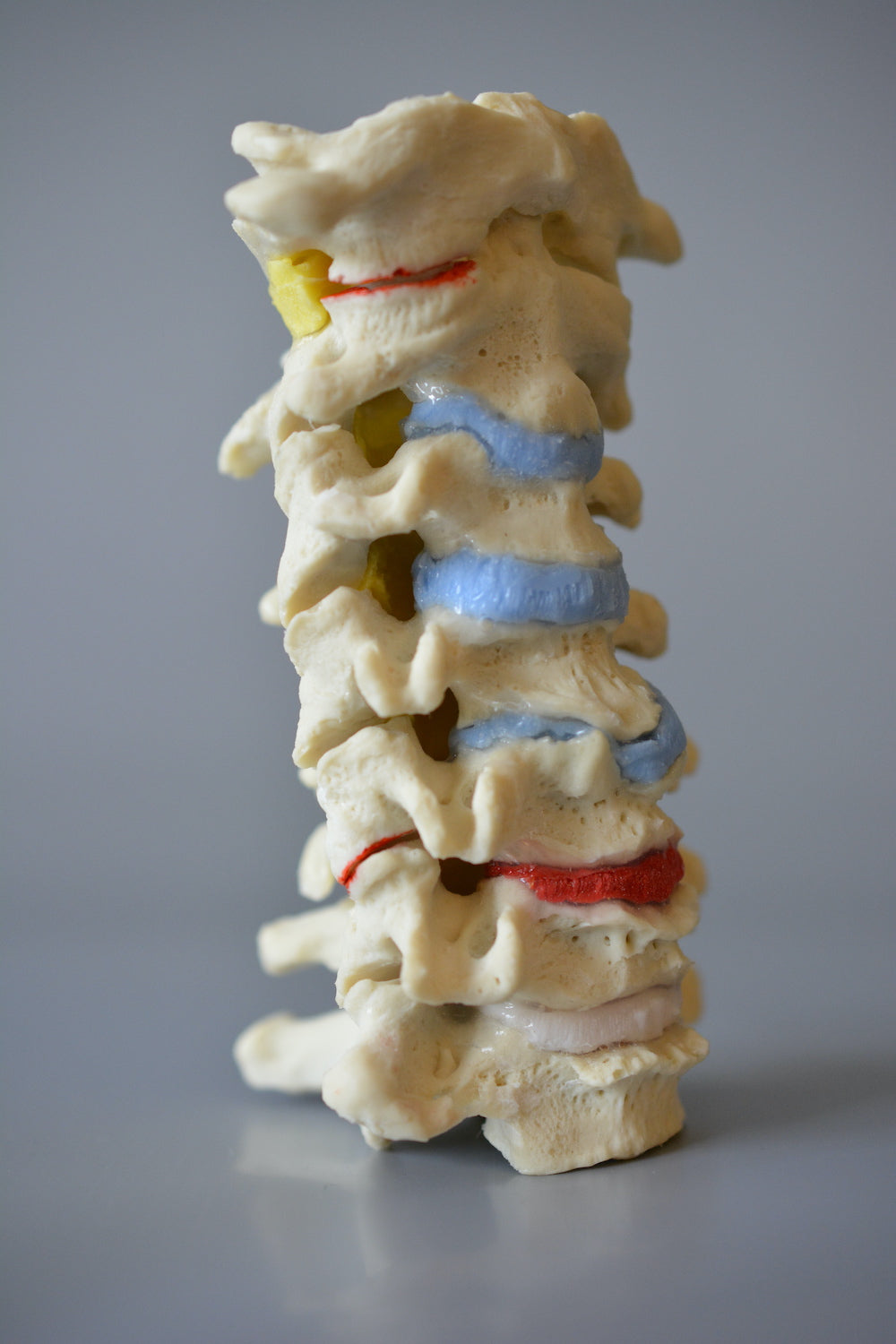 Cervical vertebrae m. degenerative changes