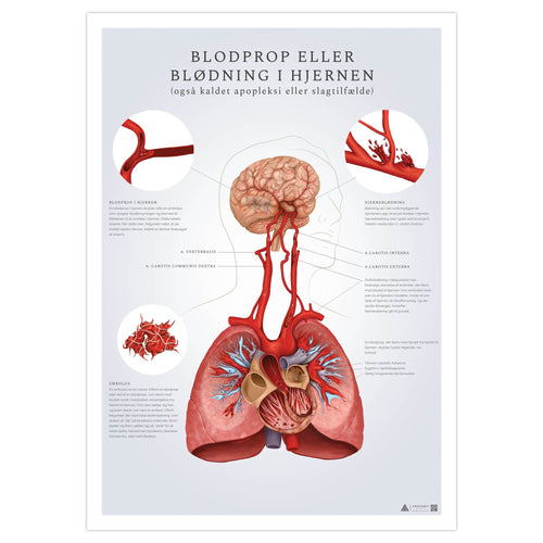 Plakat med fokus på slagtilfælde (blodprop i hjernen og hjerneblødning) - eAnatomi