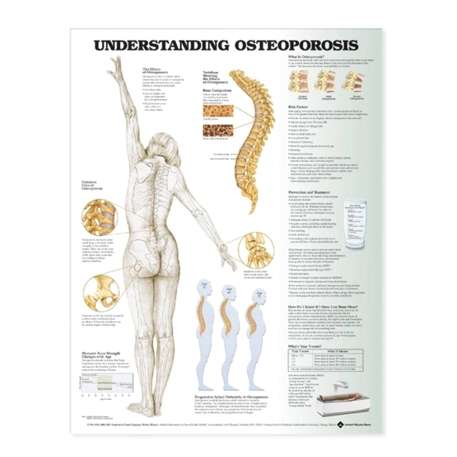 Lamineret plakat om osteoporose (knogleskørhed) på engelsk - eAnatomi
