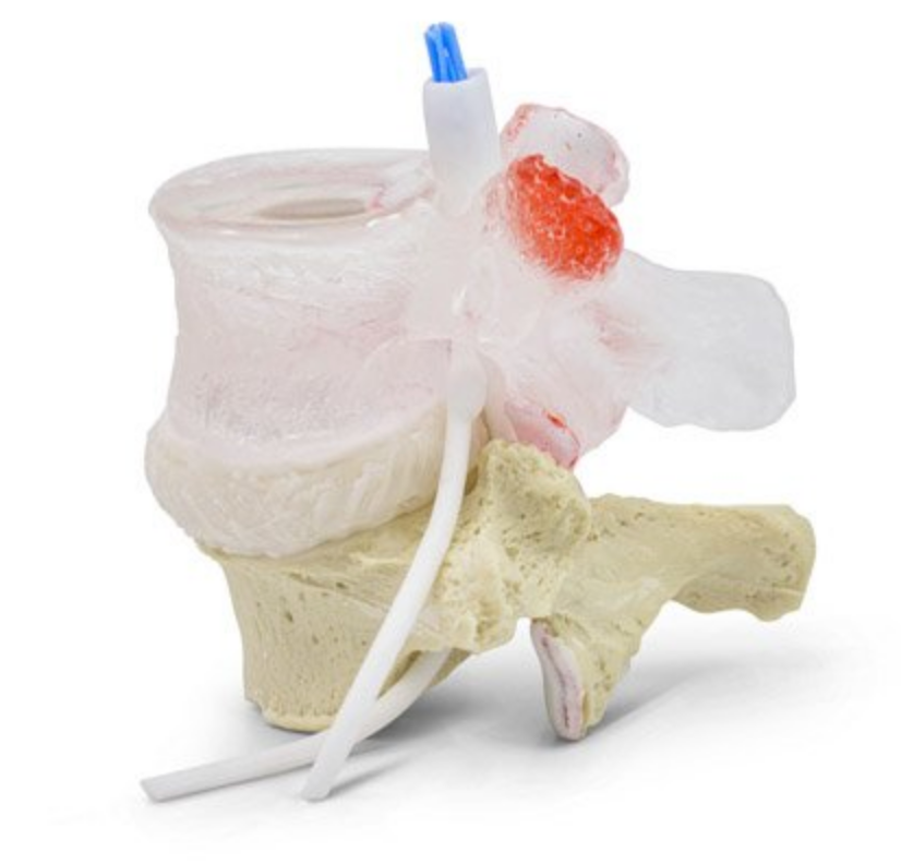 Transparent lumbar vertebra with herniated disc, vessels, lesions and cauda equina
