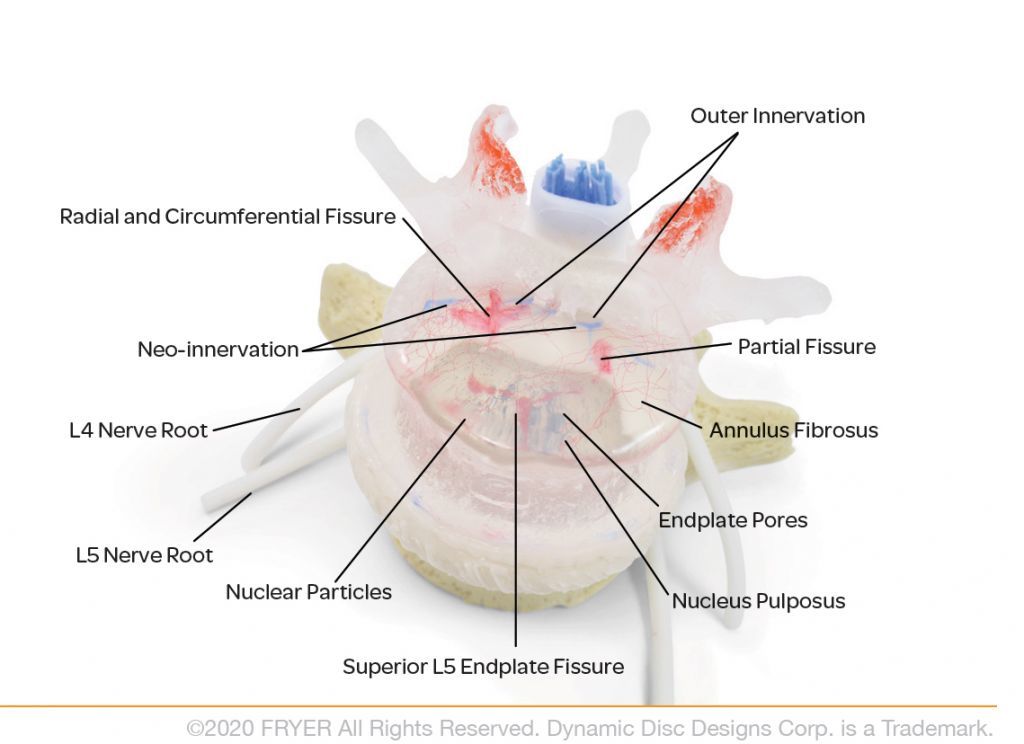 Transparent lumbar vertebra with herniated disc, vessels, lesions and cauda equina