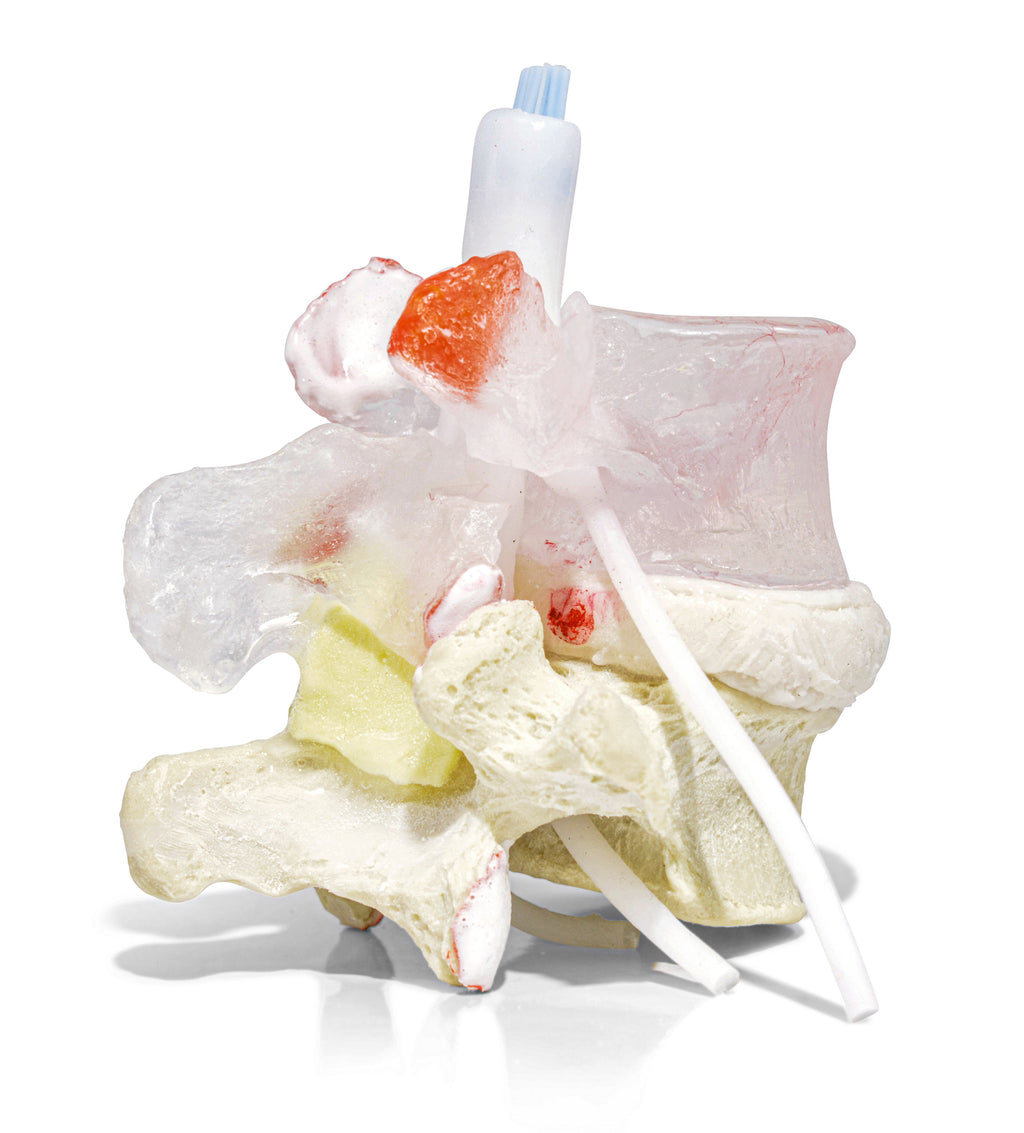 Vertebrae with spondylolysis and spondylolisthesis