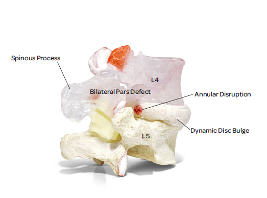 Vertebrae with spondylolysis and spondylolisthesis