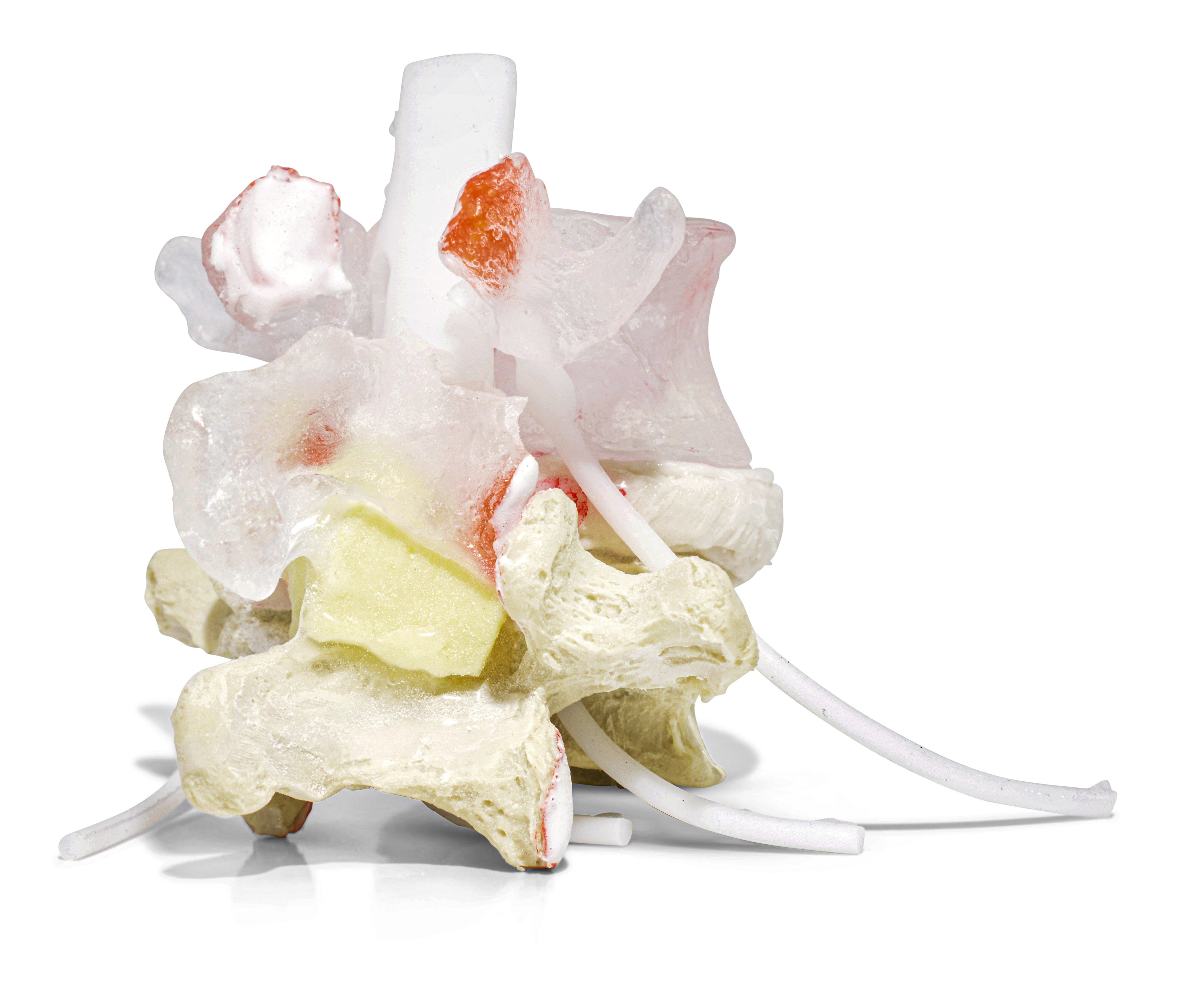 Vertebrae with spondylolysis and spondylolisthesis